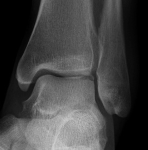 Talus OCD Anterolateral 2